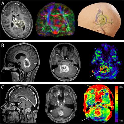 Advanced intraoperative MRI in pediatric brain tumor surgery
